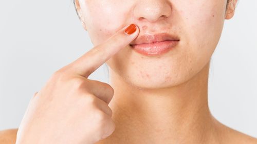 Delicious Abominations: 10 Foods That Trigger Acne Breakouts