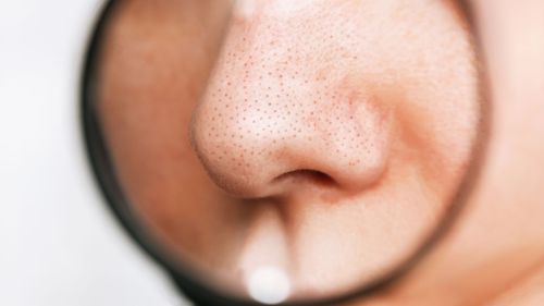 Say Goodbye To Blackheads: Effective Home Remedies For Blackheads Removal And Prevention