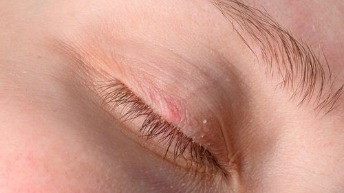Eyelash Dandruff – Why It Happens & How To Treat It Safely
