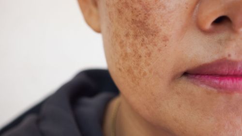 Melasma Solutions: All You Need To Know About This Skin Condition