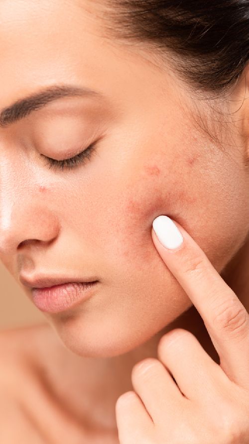 Tips To Deal With Acne, Pimple And Breakouts This Summer